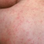 measles on a back