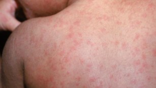 measles on a back