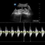 doppler crop unborn baby heartbeat