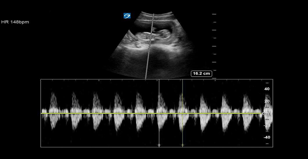 doppler crop unborn baby heartbeat