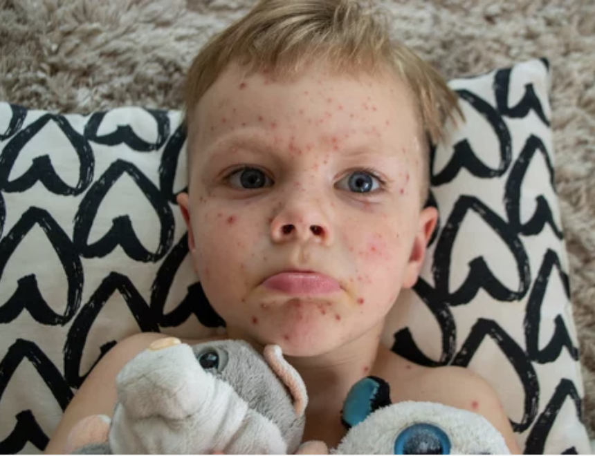 sad child with measles